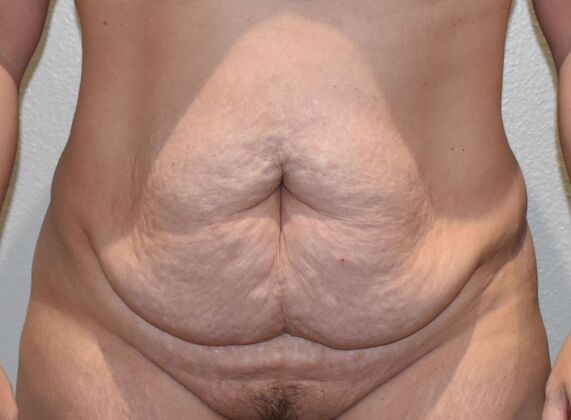 Tummy Tuck (Abdominoplasty): Case 4 - Before