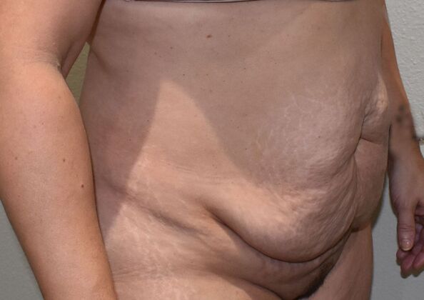 Tummy Tuck (Abdominoplasty): Case 4 - Before