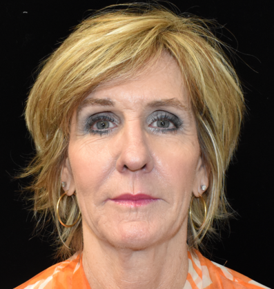 Laser Resurfacing: Case 2 - Before 