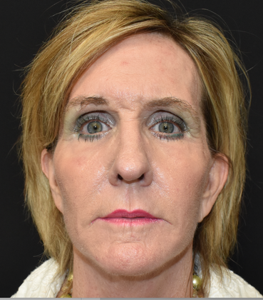 Laser Resurfacing: Case 2 - After 