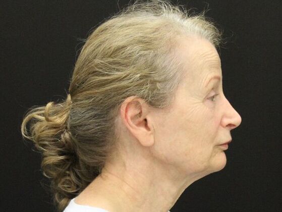 Face & Neck Lifts: Case 37 - Before