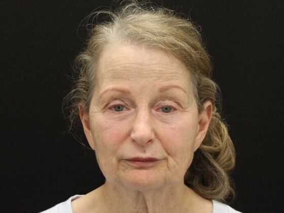 Face & Neck Lifts: Case 37 - Before