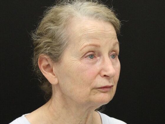 Face & Neck Lifts: Case 37 - Before