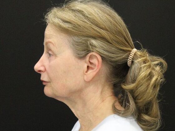 Face & Neck Lifts: Case 37 - Before