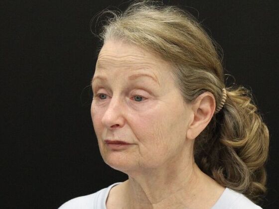 Face & Neck Lifts: Case 37 - Before