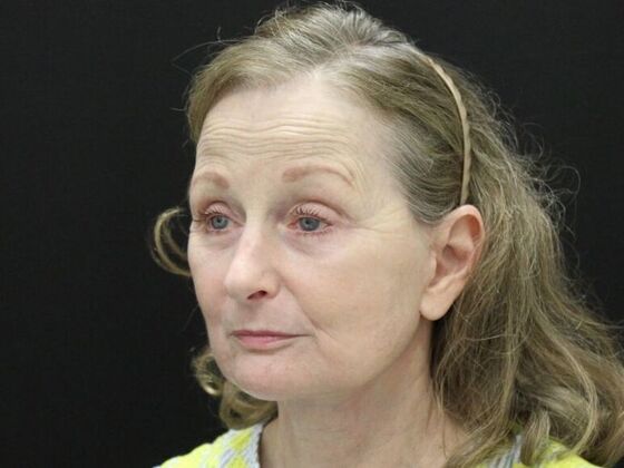 Face & Neck Lifts: Case 37 - After