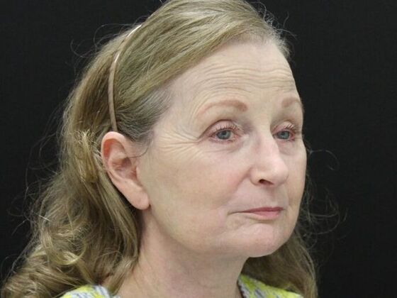 Face & Neck Lifts: Case 37 - After