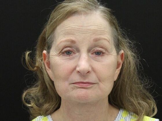 Face & Neck Lifts: Case 37 - After