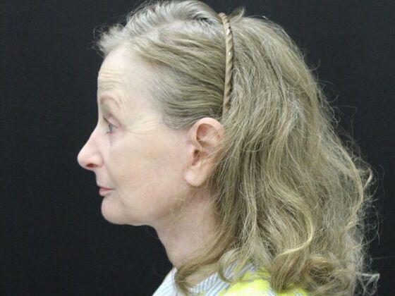 Face & Neck Lifts: Case 37 - After
