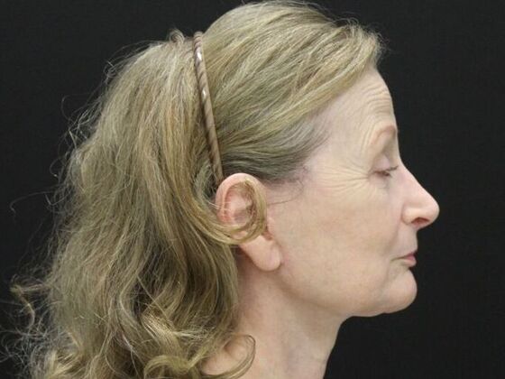 Face & Neck Lifts: Case 37 - After