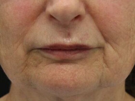 Non-Surgical: Case 7 - Before