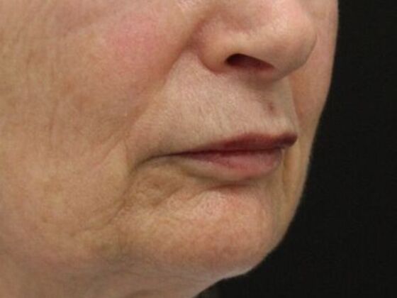 Non-Surgical: Case 7 - Before