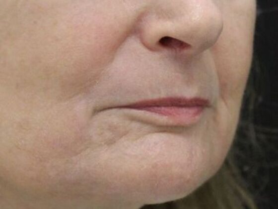 Non-Surgical: Case 7 - After