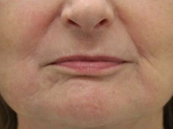 Non-Surgical: Case 7 - After