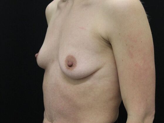 Breast Augmentation: Case 108 - Before