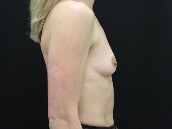 Breast Augmentation: Case 108 - Before