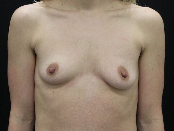 Breast Augmentation Case 108 - Before