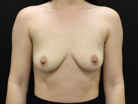 Breast Augmentation Case 109 - Before