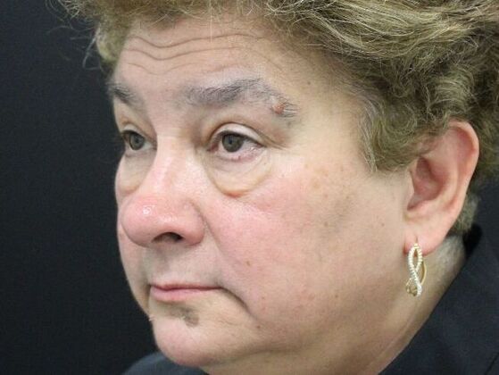 Eyelid Surgery: Case 14 - Before