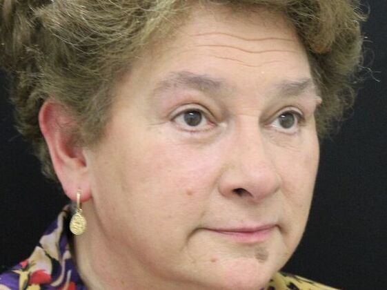 Eyelid Surgery: Case 14 - After