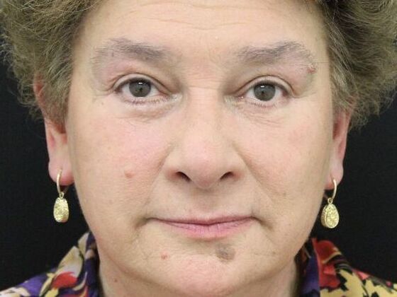 Eyelid Surgery: Case 14 - After