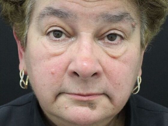 Eyelid Surgery: Case 14 - Before