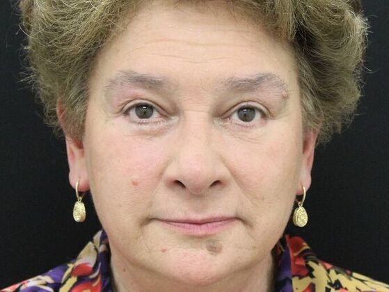 Non-Surgical: Case 8 - After