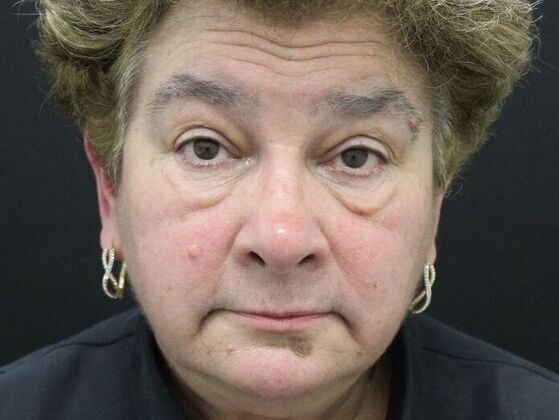 Non-Surgical: Case 8 - Before