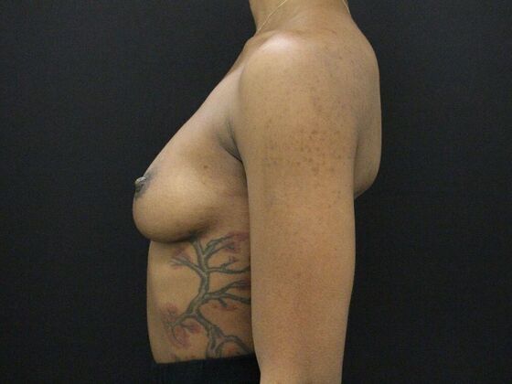 Breast Augmentation: Case 110 - Before