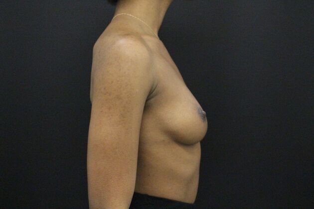 Breast Augmentation: Case 110 - Before