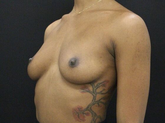 Breast Augmentation: Case 110 - Before