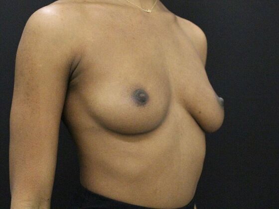 Breast Augmentation: Case 110 - Before