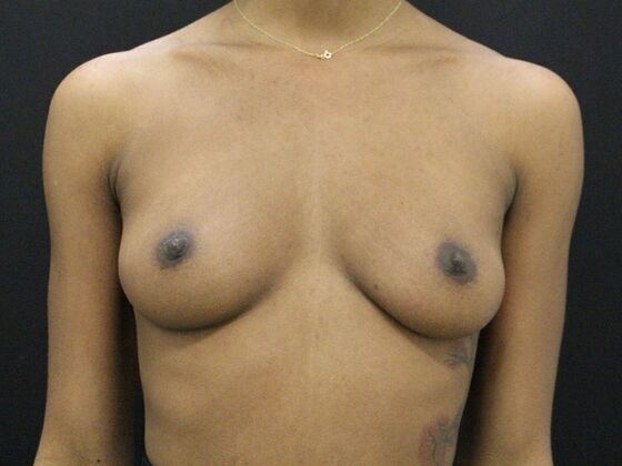 Breast Augmentation Case 110 - Before