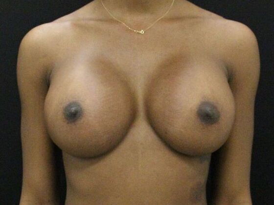 Breast Augmentation Case 110 - After
