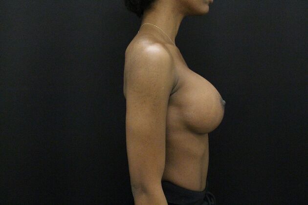 Breast Augmentation: Case 110 - After