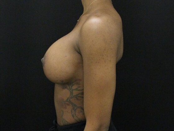 Breast Augmentation: Case 110 - After