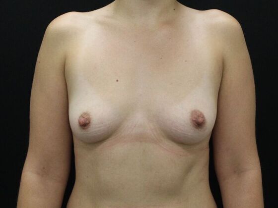 Breast Augmentation Case 111 - Before