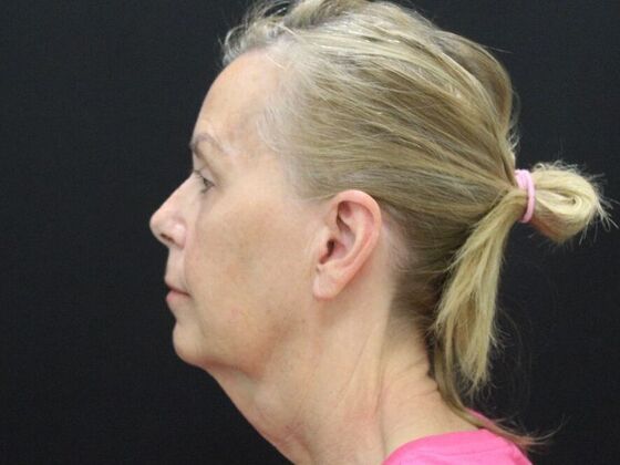 Face & Neck Lifts: Case 38 - Before
