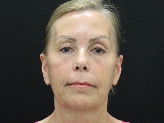 Face & Neck Lifts Case 38 - Before