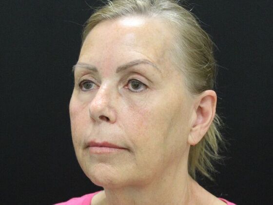 Face & Neck Lifts: Case 38 - Before