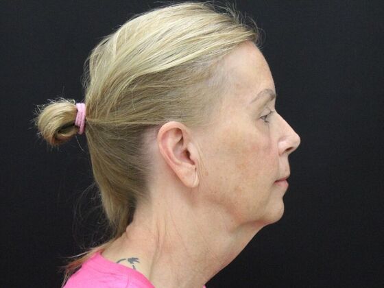 Face & Neck Lifts: Case 38 - Before
