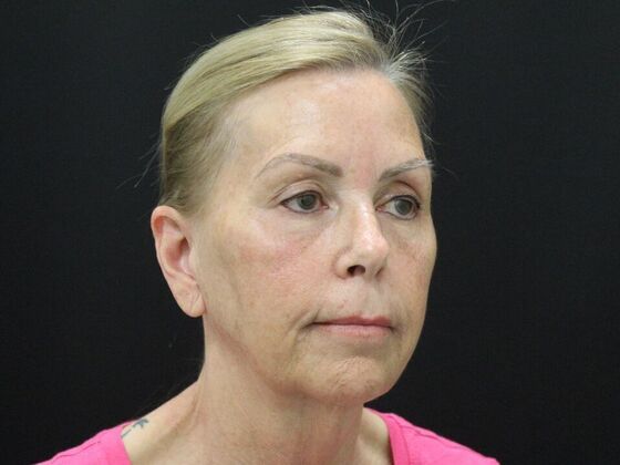 Face & Neck Lifts: Case 38 - Before