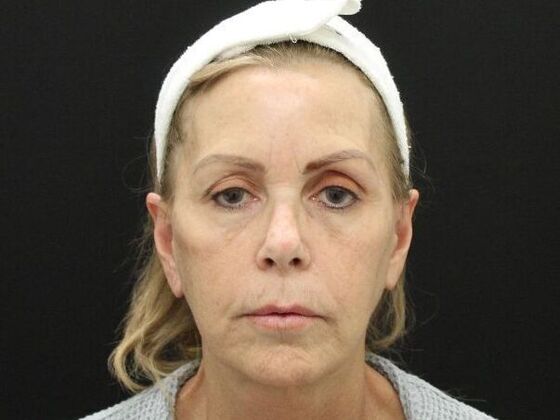 Face & Neck Lifts Case 38 - After