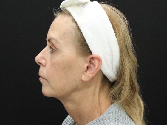 Face & Neck Lifts: Case 38 - After