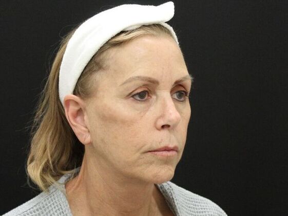 Face & Neck Lifts: Case 38 - After