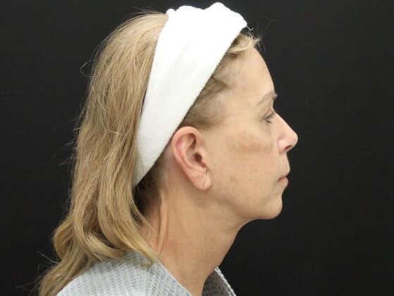 Face & Neck Lifts: Case 38 - After