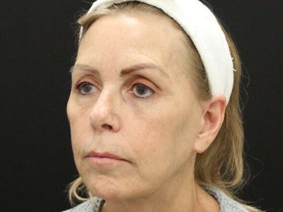 Face & Neck Lifts: Case 38 - After