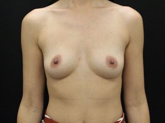 Breast Augmentation: Case 112 - Before