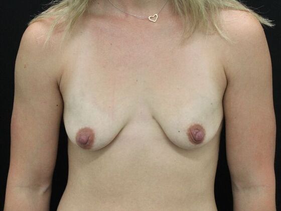 Breast Lift/Breast Lift Augmentation Case 52 - Before