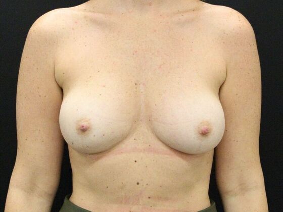 Breast Augmentation Case 113 - Before